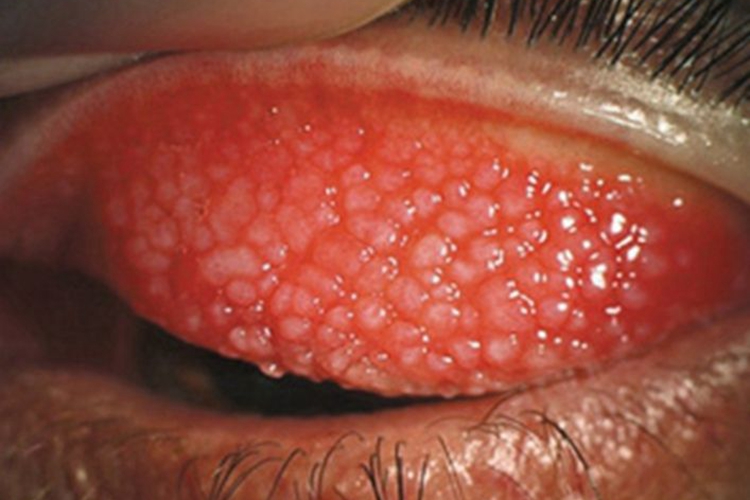 儿童过敏性结膜炎眼睑白点图