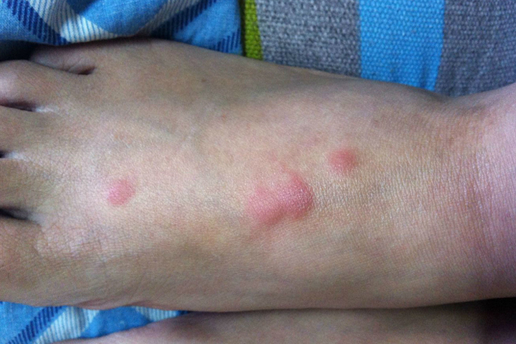 脚上丘疹性荨麻疹丘疹图 脚上丘疹性荨麻疹丘疹图