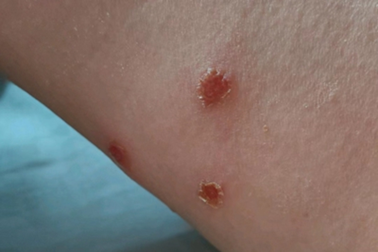 非大疱型脓疱疮大腿结痂图