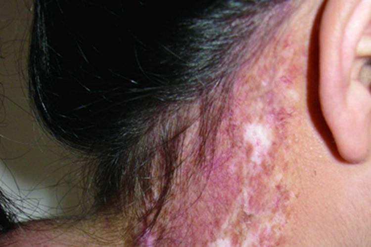 慢性放射性皮炎颈部白斑图