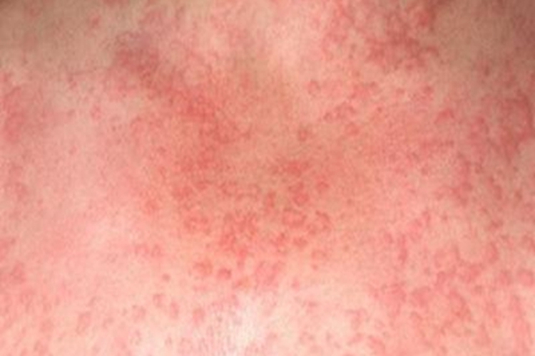 水源性荨麻疹胸部风团图 水源性荨麻疹胸部风团图