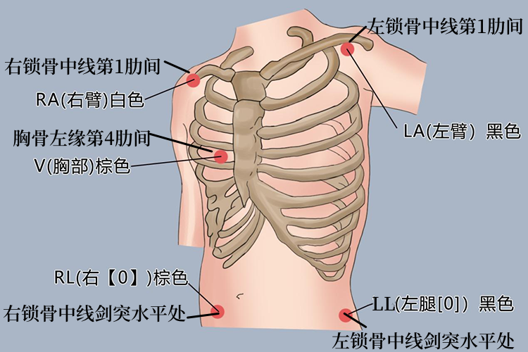 心电监护5个位置及颜色图 心电监护5个位置及颜色图