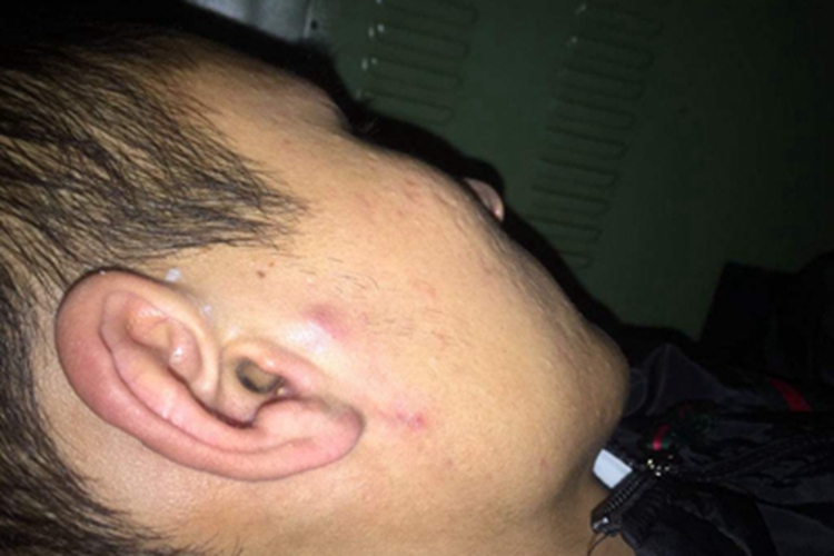 虱病耳周症状图