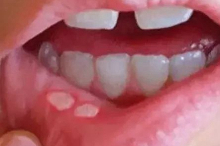 二期口腔梅毒唇内侧症状图