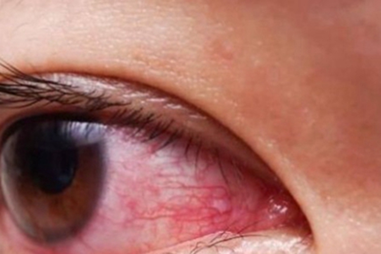 旋毛虫病症状图