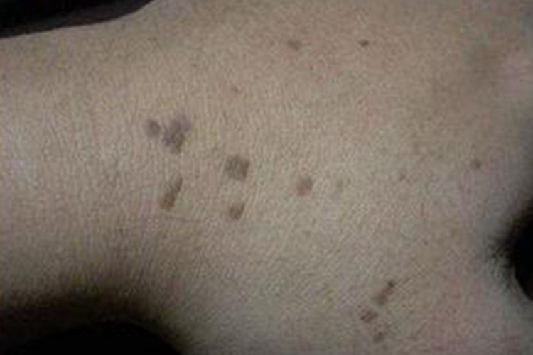 疣手背黑斑图 疣手背黑斑图