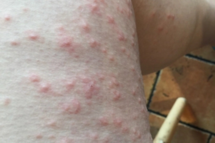 妊娠多形疹大腿小红疙瘩图 妊娠多形疹大腿小红疙瘩图