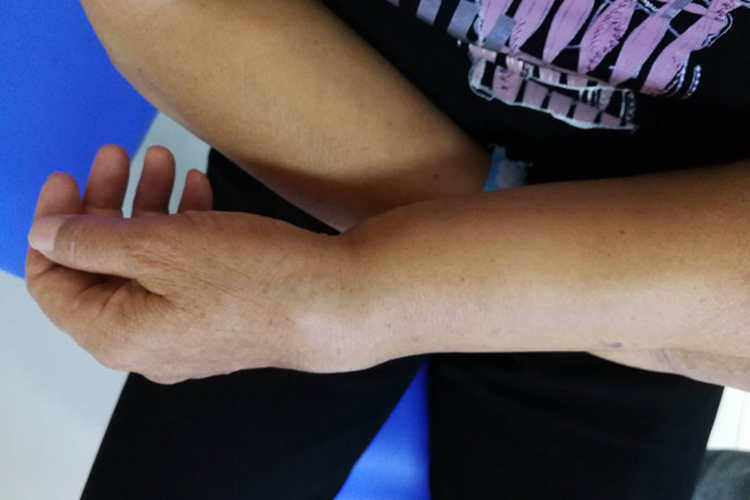 骨折移位明显时,腕部呈典型的餐叉样及枪刺样畸形,手指处可半屈曲休息