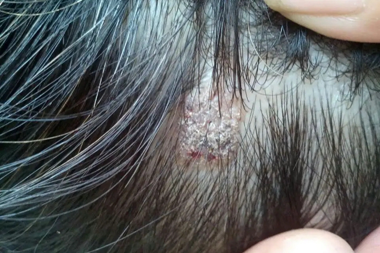 脂溢性皮炎头皮屑图