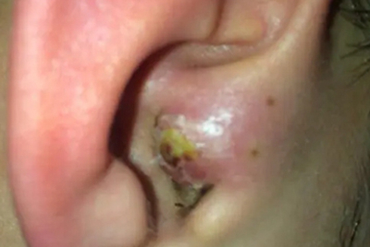 坏死性外耳道炎耳朵里流脓图 坏死性外耳道炎耳朵里流脓图