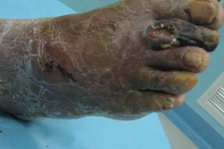 湿性坏疽脚背皮肤发黑图