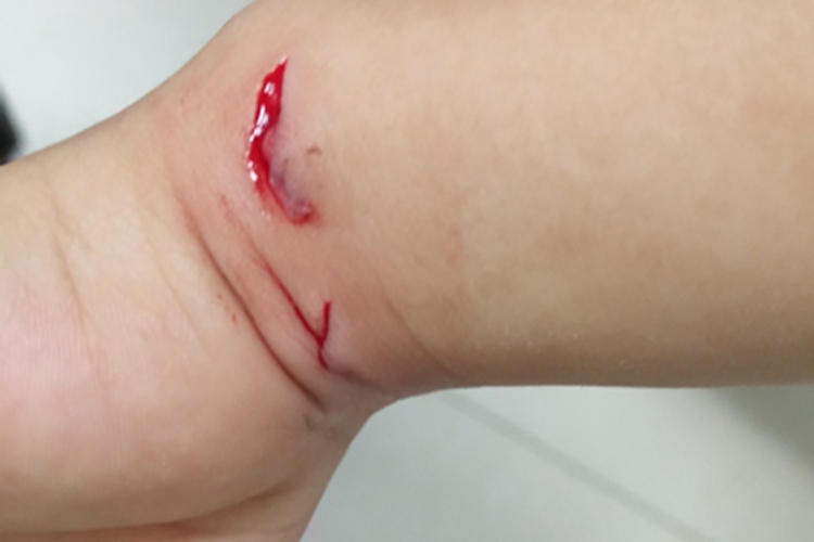 跌伤手腕裂口图