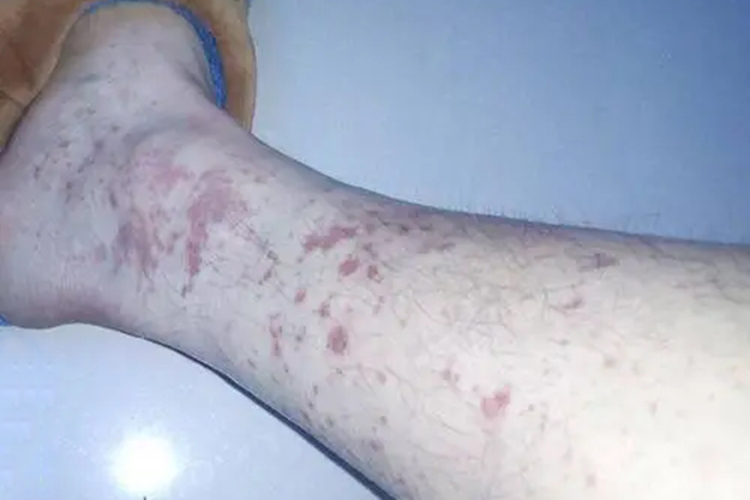 特发性血小板减少性紫癜紫块图