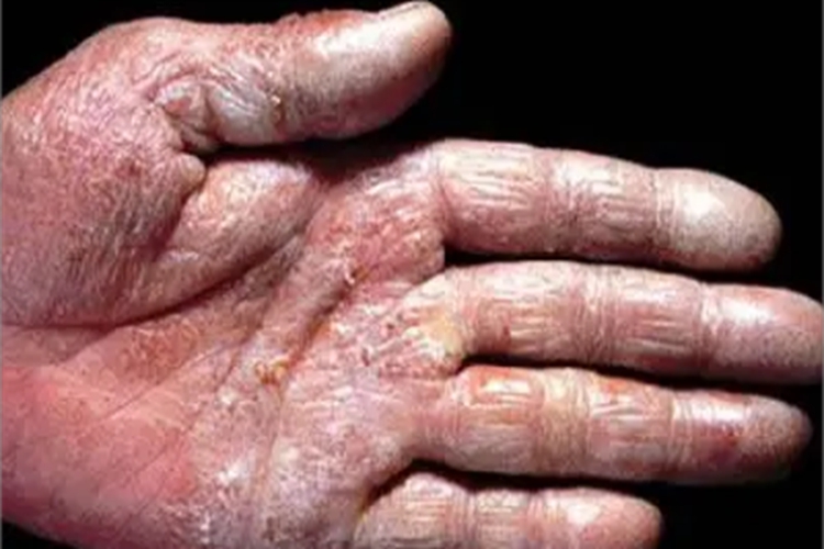 浸渍擦烂性皮炎手部症状图 浸渍擦烂性皮炎手部症状图