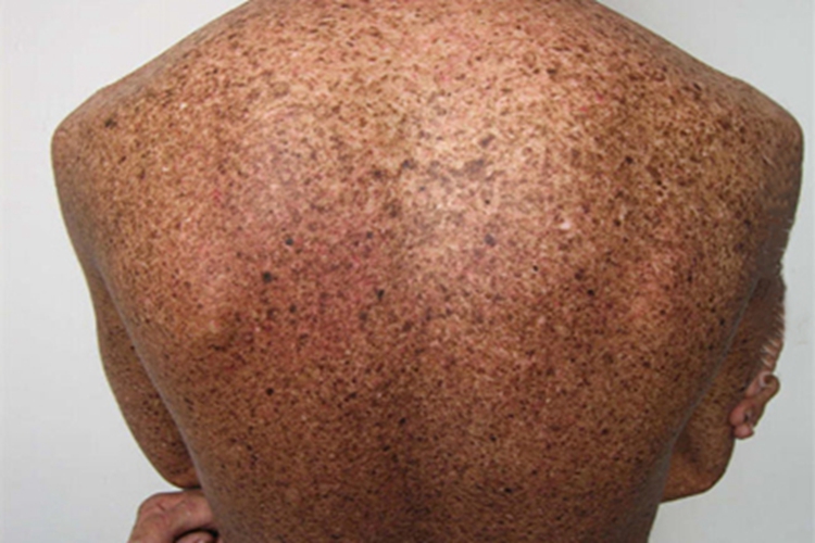 着色性干皮病后背褐色斑点图