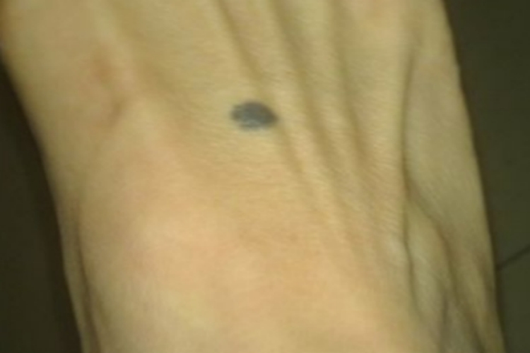 浅表扩散性黑素瘤症状图