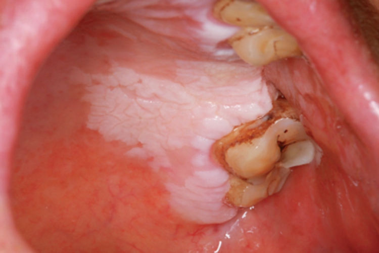 口腔白斑病口腔斑块图