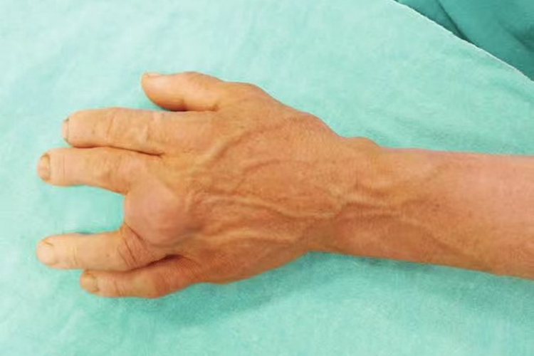 手背脂肪瘤图 手背脂肪瘤图