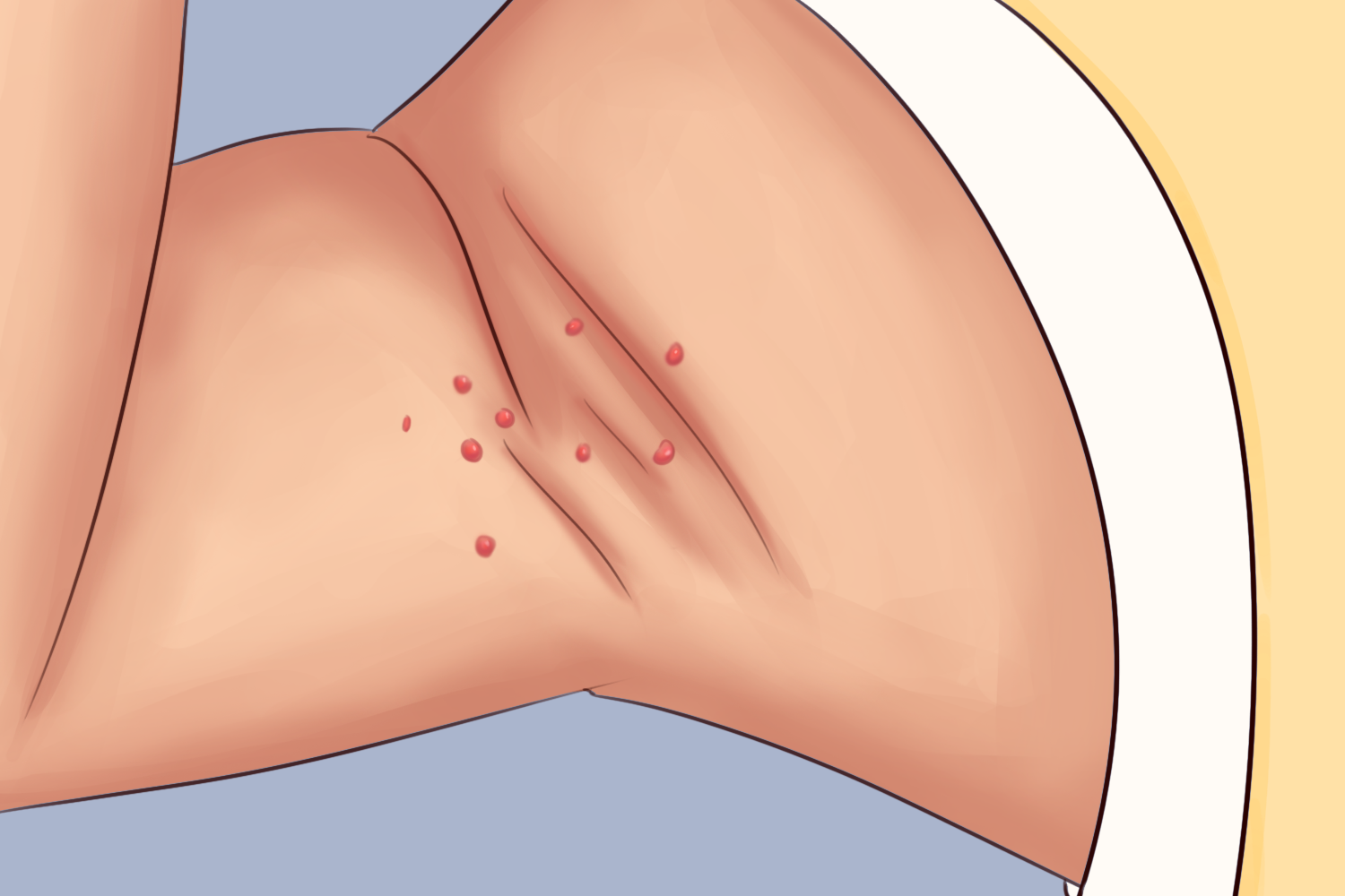 腋窝下传染性软疣图