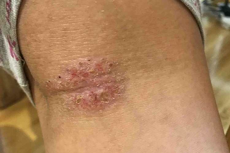 湿疹肘部结痂图 湿疹肘部结痂图