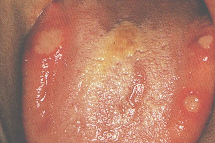 口腔单纯疱疹图