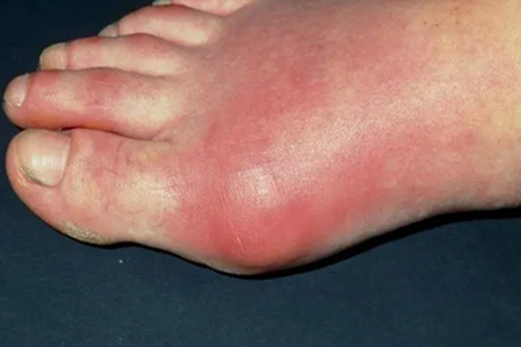 痛风大脚趾红肿发亮图 痛风大脚趾红肿发亮图