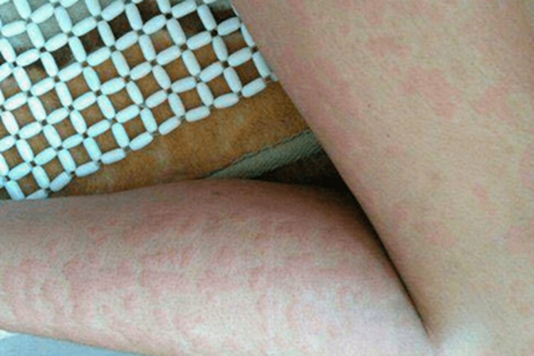 痒疹腿部风团图