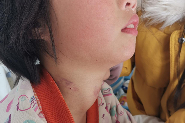 小儿甲状腺功能亢进症甲状腺肿大图