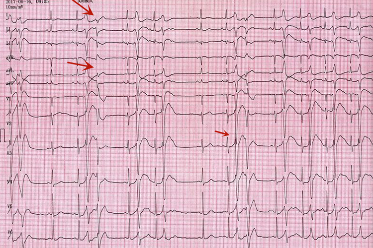 B型RonT现象心电图