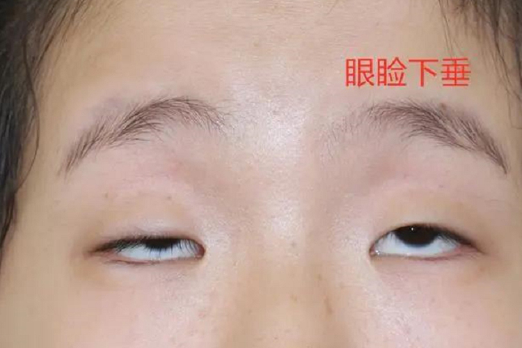 鼻咽癌眼睑下垂图 鼻咽癌眼睑下垂图