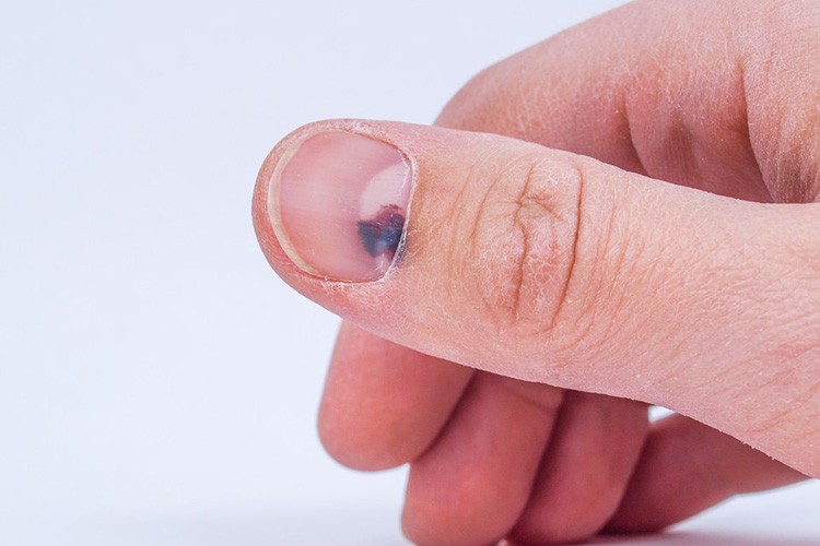 手部甲下图血肿