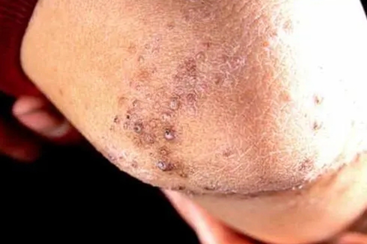 穿通性疾病肘部皮肤粗糙图