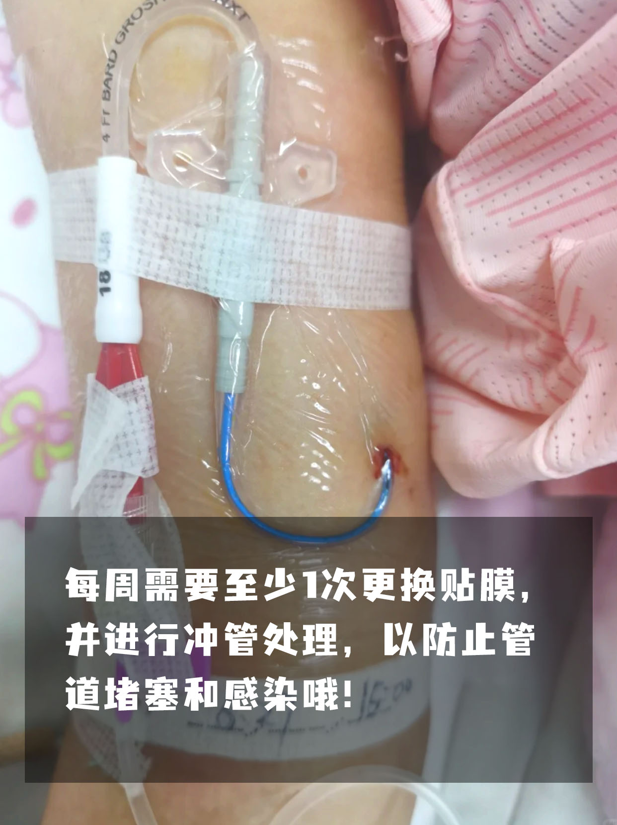 PICC门诊是什么科？功能与作用详解！