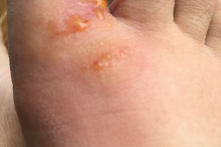 跳蚤叮咬脚部水疱图