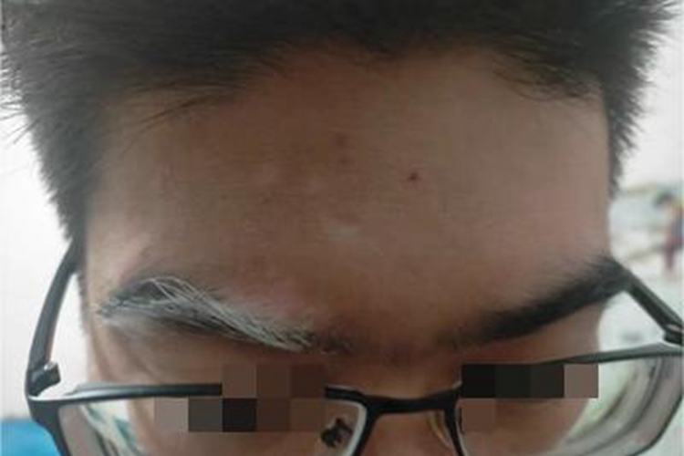 白癜风眉毛毛发变白图