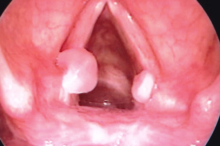 声带肉芽肿初期图