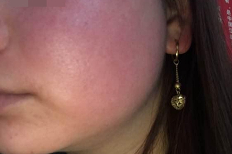 一氧化碳中毒面部症状图