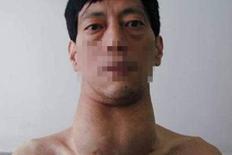 甲亢脖子粗及突眼图