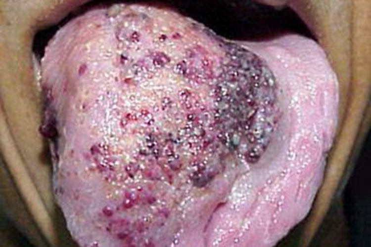 海绵状淋巴管瘤舌头水肿图 海绵状淋巴管瘤舌头水肿图