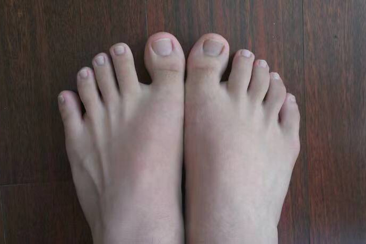 正常拇趾图