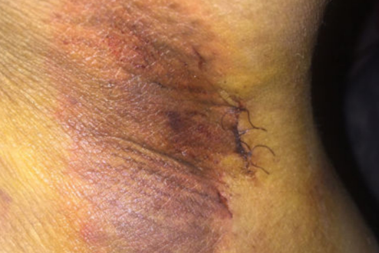 小切口修剪术术后一周图 小切口修剪术术后一周图