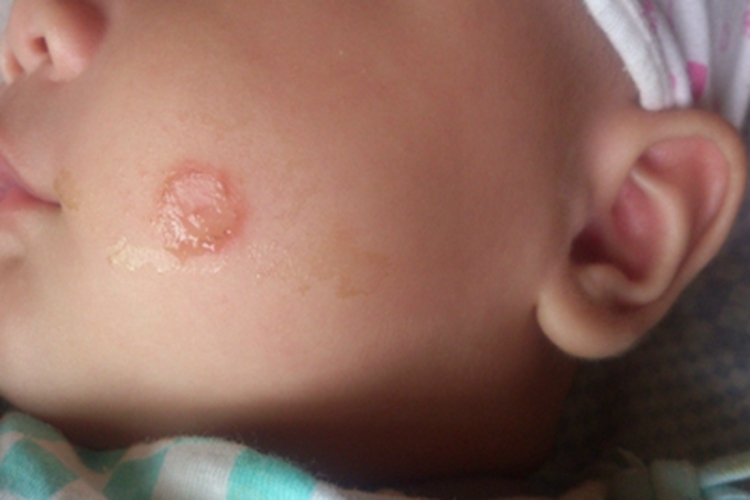 急性点滴型儿童银屑病面部渗液图