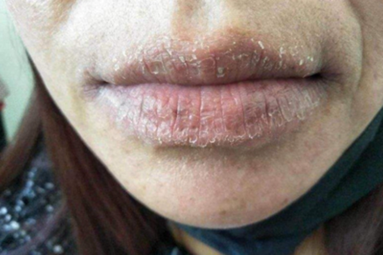 剥脱性唇炎嘴唇皮肤干裂图