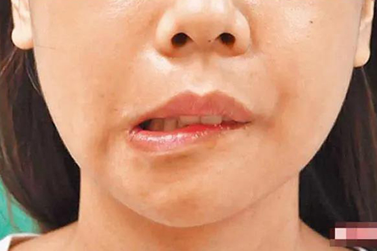 面神经炎导致下巴萎缩图