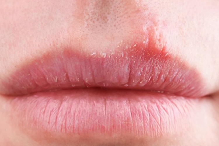 干燥综合征嘴唇脱屑图