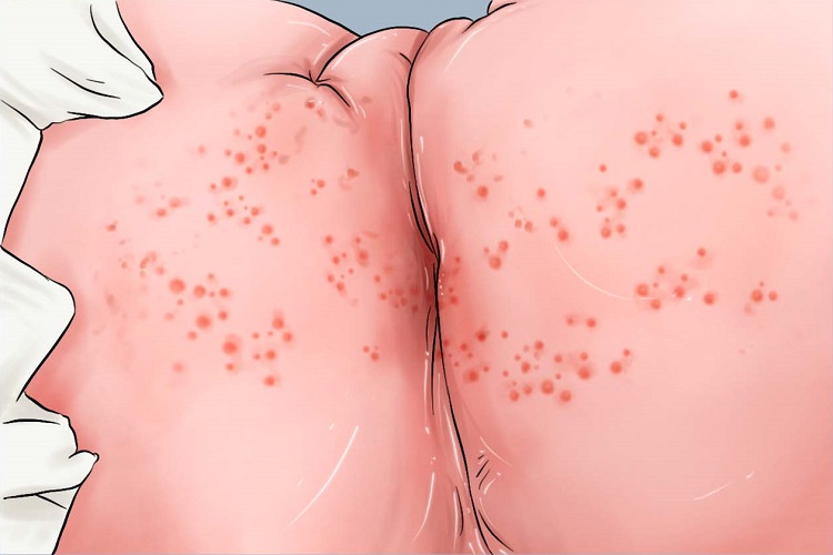 特应性皮炎臀部丘疹手绘图