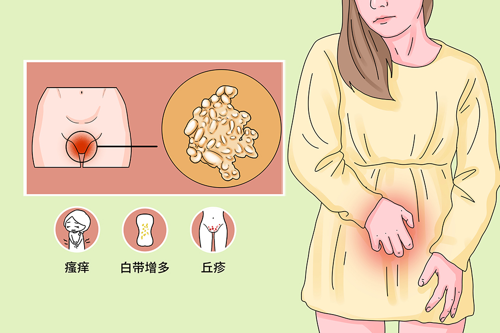 是否医保 是 英文名称 pseudocondyloma 疾病别称 绒毛状小阴唇