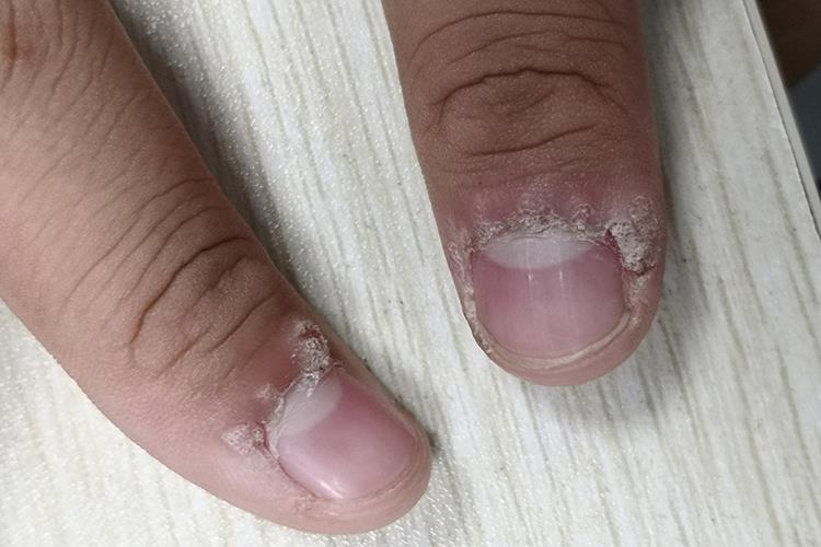 白色老鼠痣图