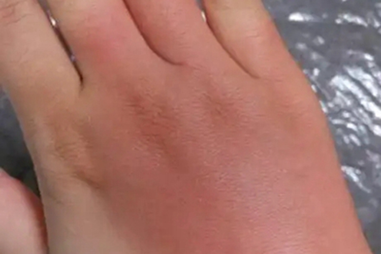 红斑性肢痛症手部红肿图