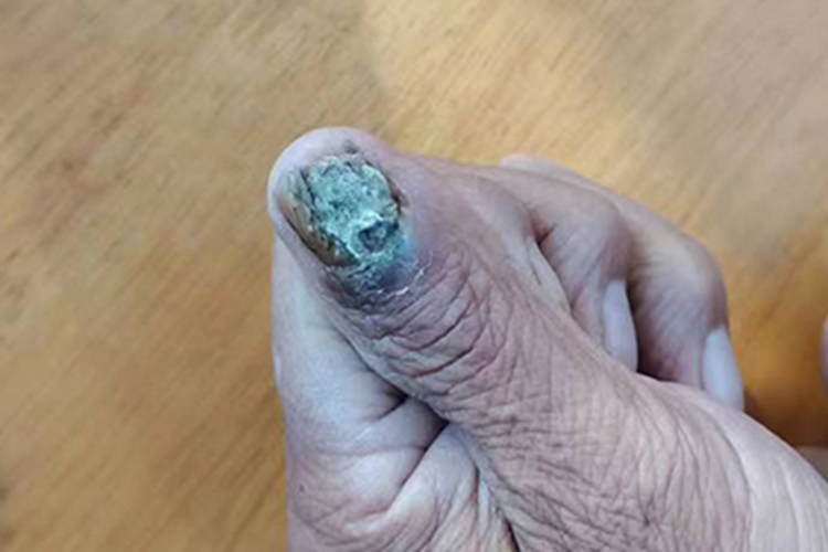 恶性黑色素瘤手指甲溃疡图